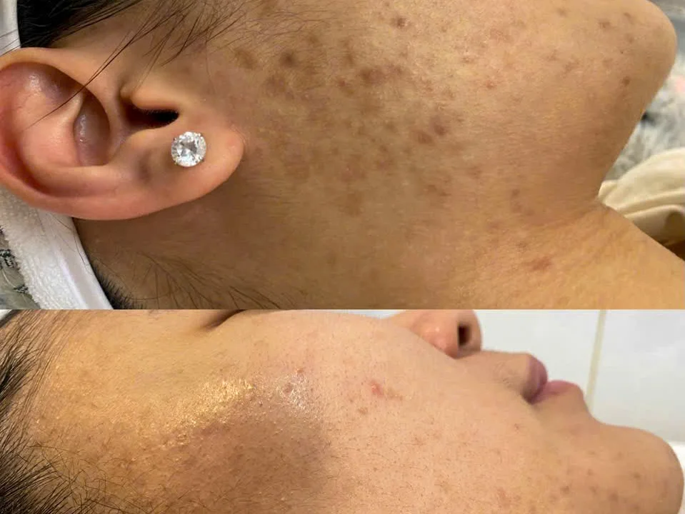 Kết quả điều trị mụn tại Harmonie Beauté Tân Định — trước và sau